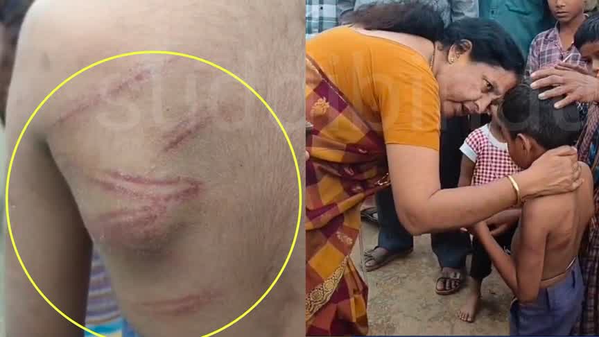 Teacher/ಪಾಠ ಕಲಿಯಲಿಲ್ಲ ಎಂಬ ಕಾರಣಕ್ಕೆ ವಿದ್ಯಾರ್ಥಿಗೆ ಥಳಿತ : ಬಾಸುಂಡೆ ಮೂಡಿಸಿದ ಶಿಕ್ಷಕಿ