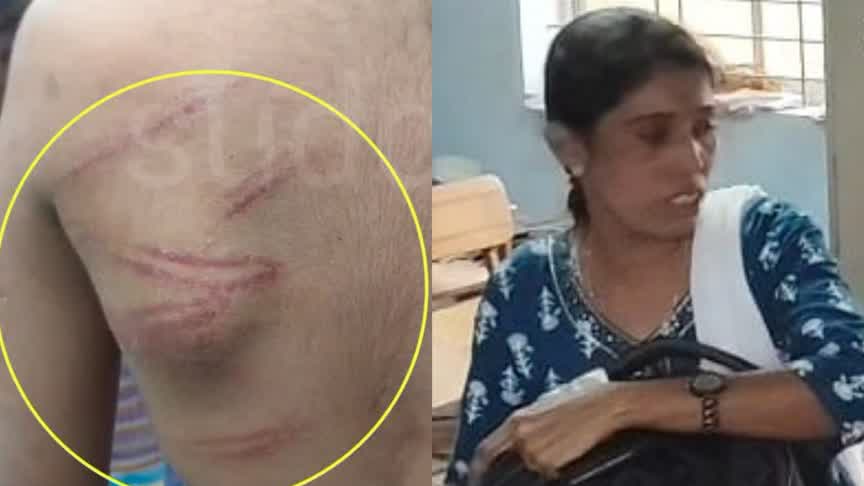 Teacher suspended/ವಿದ್ಯಾರ್ಥಿಗೆ ಥಳಿಸಿದ ಪ್ರಕರಣ : ಶಿಕ್ಷಕಿ ಅಮಾನತು.